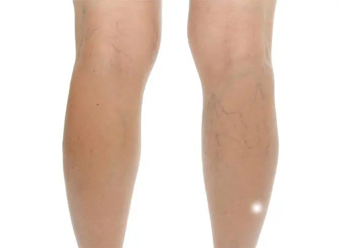 sclerotherapy