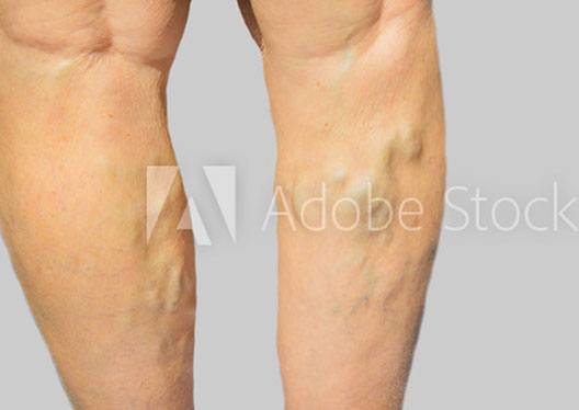 How to prevent Varicose Veins?