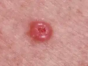 Basal Cell Carcinoma