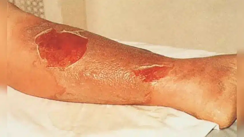 wound care treatment for Cellulitis