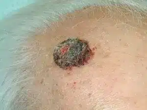 Squamos Cell Carcinoma