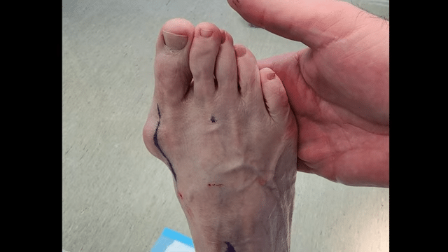 Bunion Correction