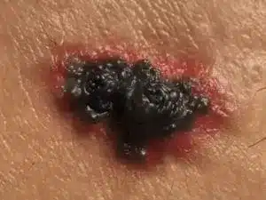 Malignant Melanoma